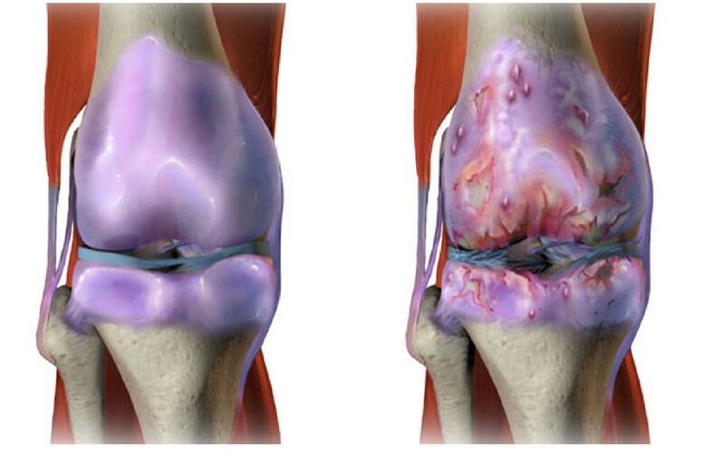 gesonde Knorpel an Zerstéierung vum Kniegelenk mat Arthrosis