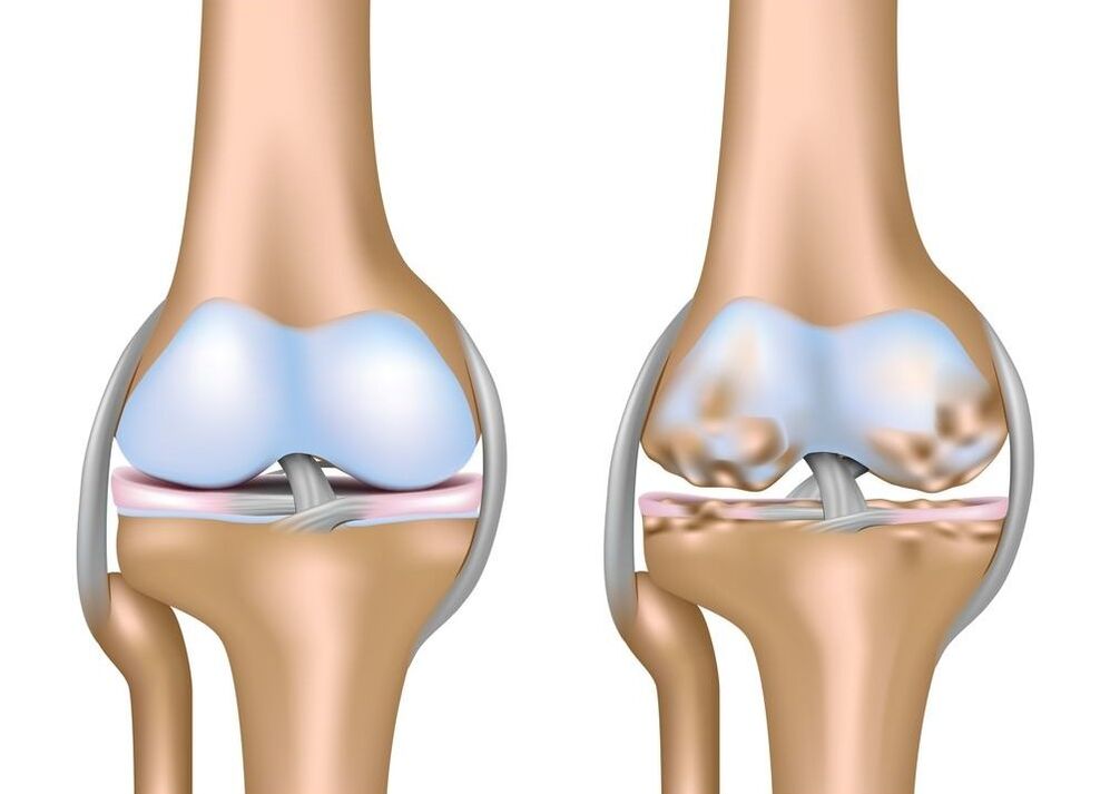 Vergréisserung vun Arthrosis vun de Gelenker
