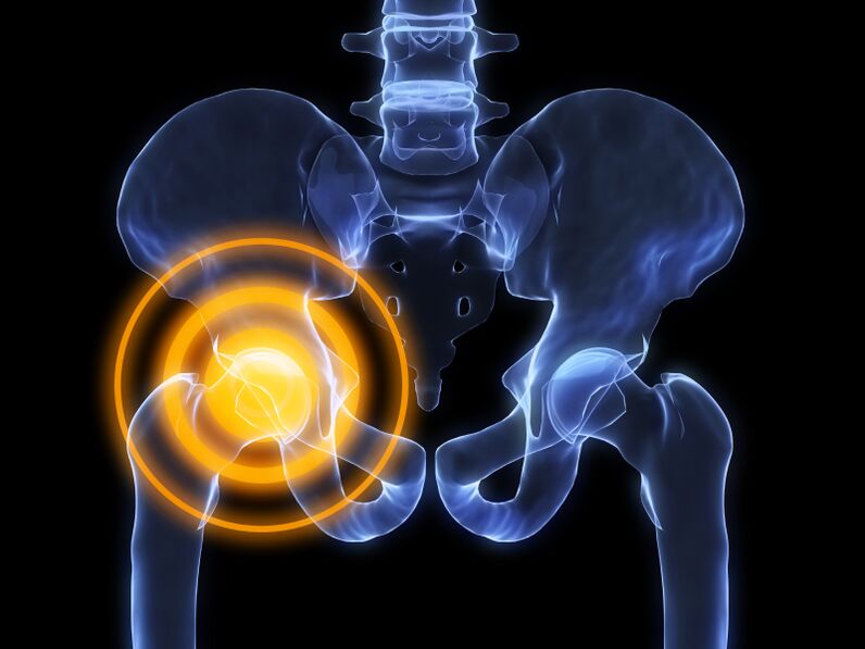 Arthrosis vum Hip Gelenk